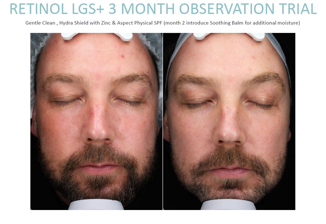 ASPECT Retinol LGS+
