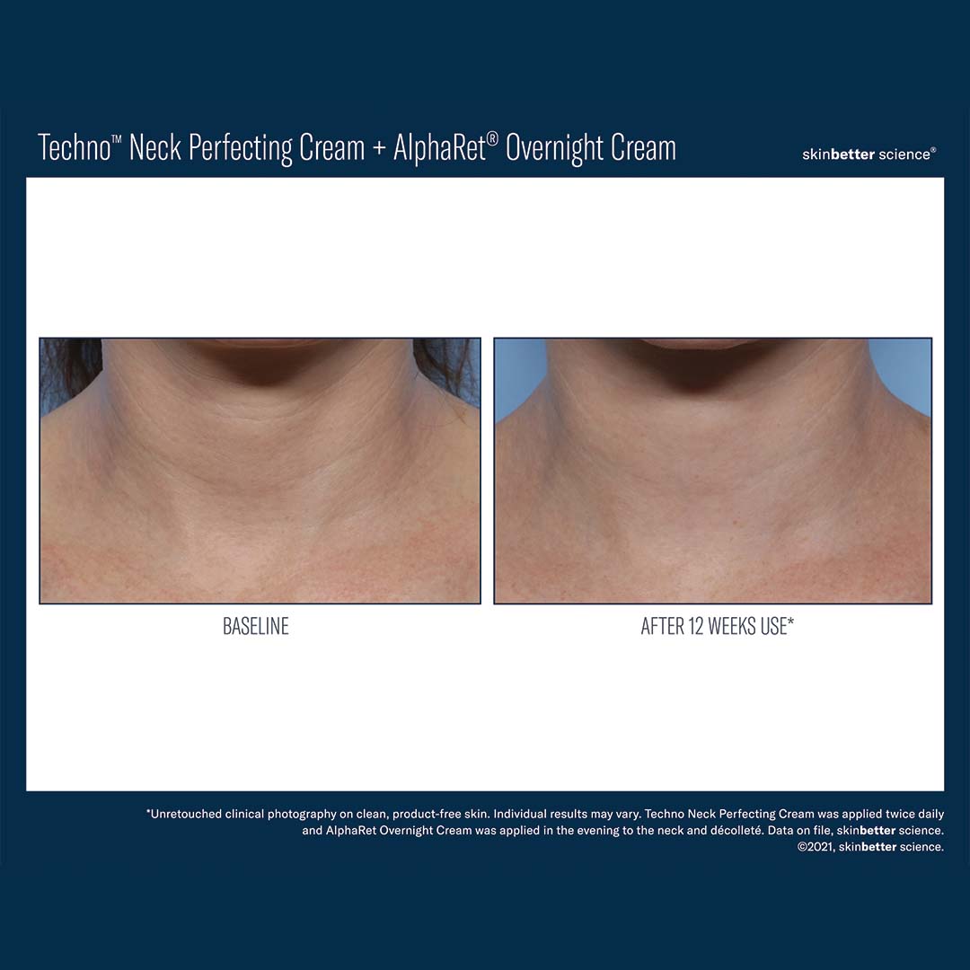 SKIN BETTER SCIENCE - Interfuse Treatment Cream Face and Neck
